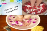 How to treat fungal nail