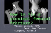 How to Fix a Prox Femur Fx