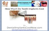 How Much Do Tooth Implants Cost