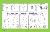 Precocious puberty