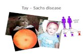 Tay – sachs disease