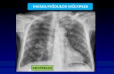 MASAS/NÓDULOS MÚLTIPLES METÁSTASIS. EPOC Bronquitis crónica Enfisema Es un dx clínico, no rx 50% rx normal Signos + frec: Engrosamiento de la pared del.