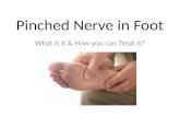 How to Get Rid of Pinched nerve in foot