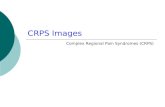 CRPS Images Complex Regional Pain Syndromes (CRPS)