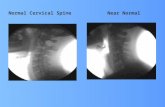 Normal Cervical Spine Near Normal. Normal Cervical Spine Phase 1 Degeneration
