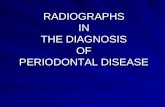 Radio Graphic Aids - Diagnosis Periodontal Diseases Kalps Ppt