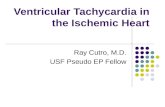Ventricular Tachycardia in the Ischemic Heart[1]