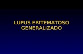 LUPUS ERITEMATOSO GENERALIZADO. BREVE HISTORIA DEL LUPUS