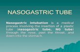 Nasogastric Tube by Lawrence Aninag