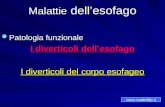 Malattie dellesofago Patologia funzionale I diverticoli dellesofago I diverticoli del corpo esofageo .