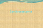 Oral Carcinosarcoma