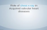 Acquired valvular heart diseases with x ray findings