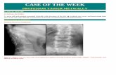 Case record... Spinal dysraphism