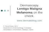 Dermoscopy. Lentigo maligna melanoma on the cheek.