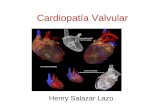 Cardiopatía Valvular