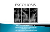 Escoliosis Idiopatica