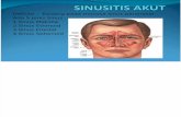 Sinusitis Akut