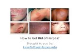 Get Rid of Your Herpes Now!