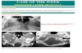 Case record...Glomus jugulare tumor