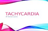 Tachycardia .. heart disease