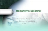 Hematoma epidural