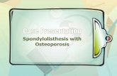 Spondylolisthesis with gross osteoporosis