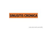 Sinusitis cronica - juan carlo santillan nuñez