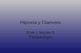 Cianosis e Hipoxia