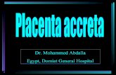 Placenta accreta-