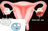 Ovarian cyst(gynec)
