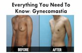 What you need to know about gynecomastia