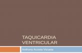 Taquicardia ventricular: electrocardiograma