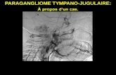 Paragangliome tympano-jugulaire