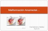 Malformación anorrectal