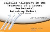 Cellular Allograft in the Treatment of a Severe Periodontal Infrabony Defect