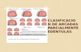 Clasificacion de arcadas parcialmente edéntulas (clasificación de Kennedy)