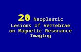 20 neoplastic lesions of vertebrae on magnetic resonance