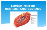 Lower Motor Neuron Lesions