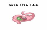 GASTRITIS Flip Chart