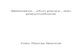 Ppt Pneumothorax , Efusi Pleura , Dan Ateletaksis, Stevanus Jonathan 07120100070