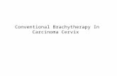 Conventional Brachytherapy in carcinoma cervix