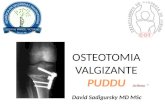 Osteotomia Valgizante do Joelho com Técnica de Puddu (Arthrex®) - David Sadigursky