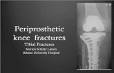 3.3 Tibial Fractures