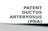 patent ductus arterius