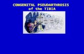 ICLL: CPT CONGENITAL PSEUDARTHROSIS of the TIBIA.