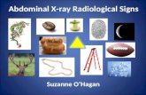 Abdominal X-ray Radiological Signs Suzanne O’Hagan.