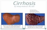 Cirrhosis by: Ashley Anderton, RN, BSN From the notes of: John Nation, RN, MSN Charlene Morris, RN, MSN Kelle Howard, MSN. RN, CNE.