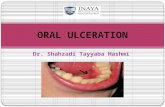 Dr. Shahzadi Tayyaba Hashmi ORAL ULCERATION. Oral mucosa is composed of stratified squamous epithelium, which covers and protects the underlying connective.