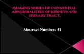 Congenital abnormalities of the kidneys and urinary tract (CAKUT) are variable, occur in 1 of 500 newborns; predisposing to development of hypertension,