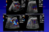 Jensen A, 1992. (Pregnancy length 147 days). Validation of CVP score Validation of CVP score The role of echocardiography in prenatal diagnosis of pulmonary.